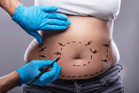 Drawing on woman's body for liposuction surgery