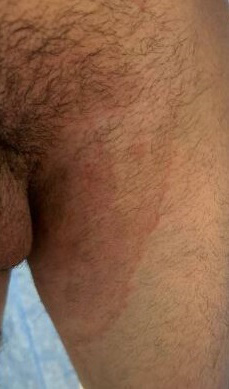 Image of man showing signs of infection by Trichophyton indotineae