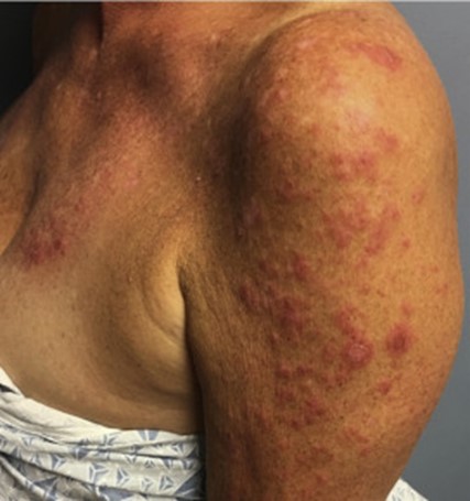 Image for DWII on immune checkpoint inhibitor-induced subacute cutaneous lupus