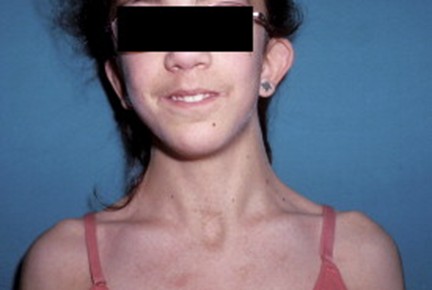 Image for DWII of Turner Syndrome