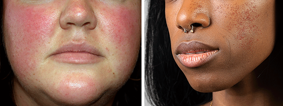 Public>Diseases>Rosacea>Overview>Skin tone comparison