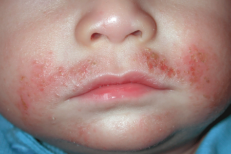 Atopic dermatitis rash and staph infection on child’s cheeks