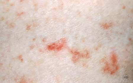 Scabies: Signs and symptoms