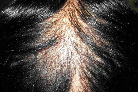 Woman with CCCA has hair loss in the center of her scalp