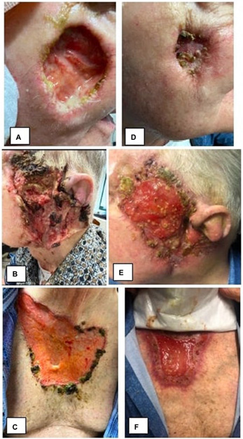 Images for DWII of pyoderma gangrenosum and anti-IL-36 therapy