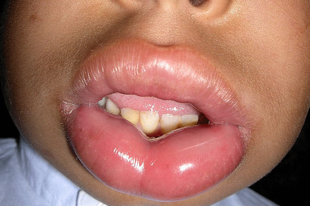 Swelling (angioedema) on bottom lip of child who has hives