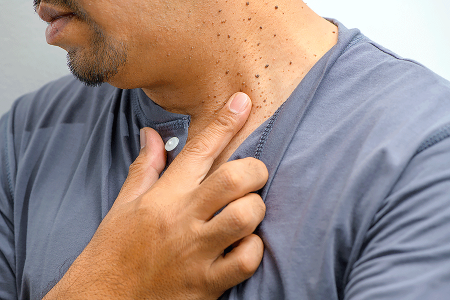 Man placing his finger just below an irritated skin tag on his neck.