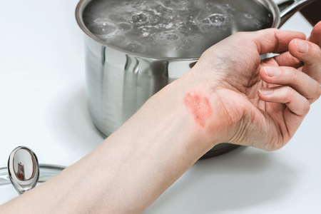 Woman's wrist with burn injury near a pot of boiling water