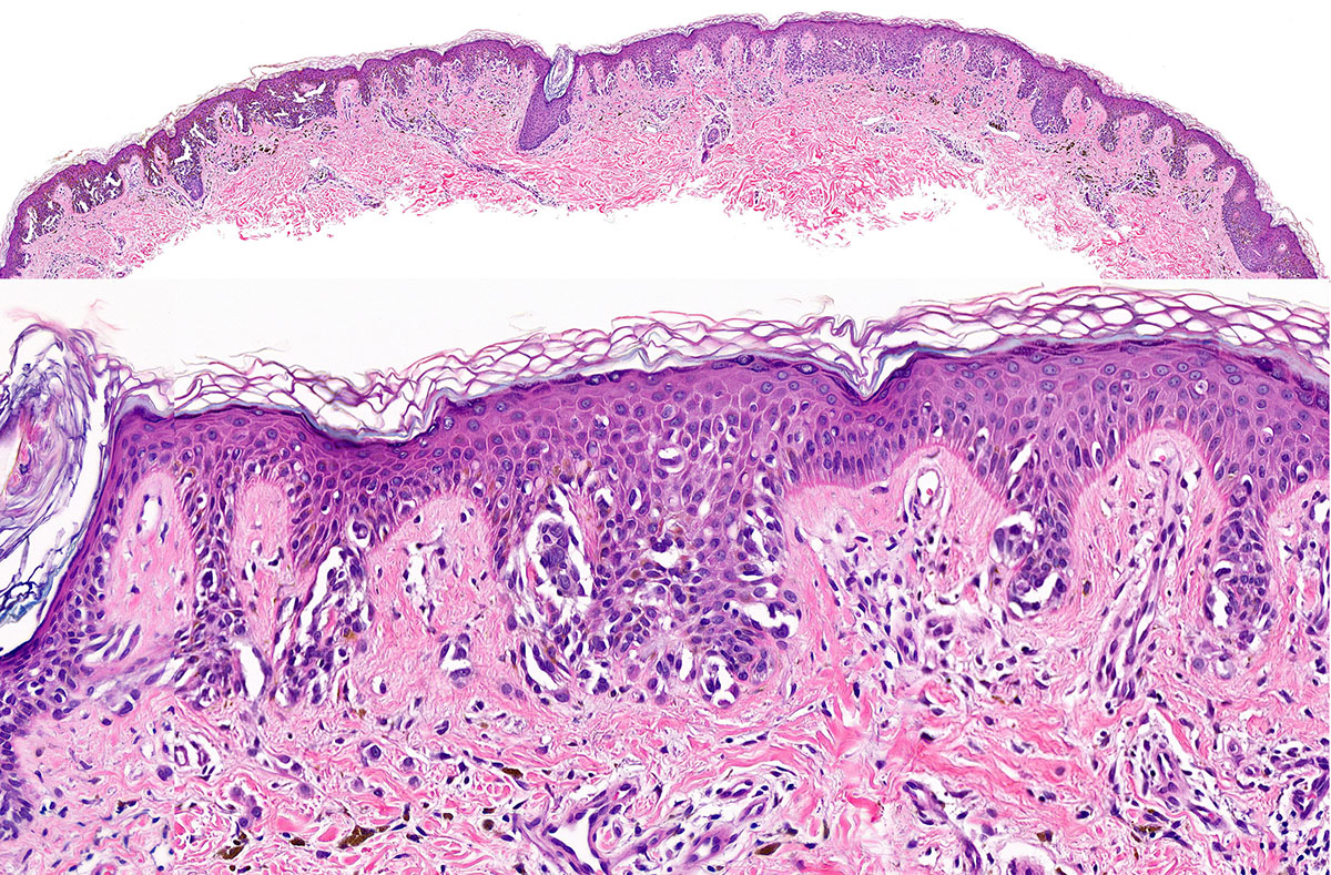 Image of histopathology for Spark nevus in DWII
