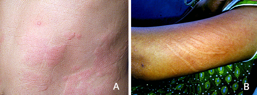 Chonic hives on patient's side and belly (left), chronic hives caused by pressure can cause lines on the skin (right).