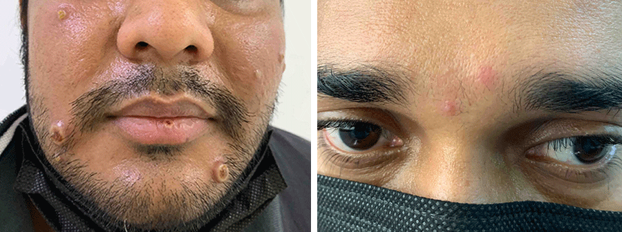 mpox on man's face (left) and two monkeypox spots on patient's face (right)