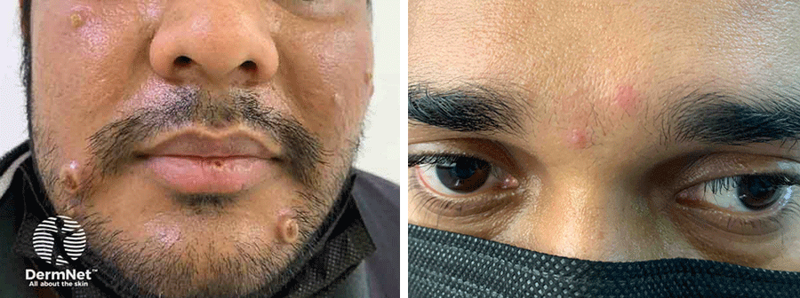 mpox on man's face (left) and two monkeypox spots on patient's face (right)