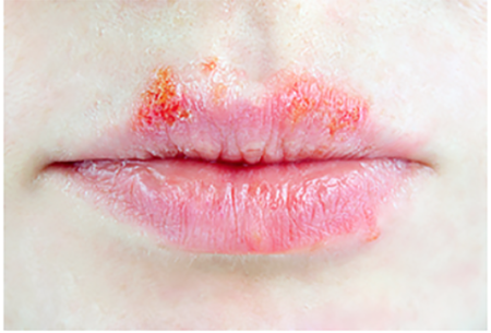 healing cold sore