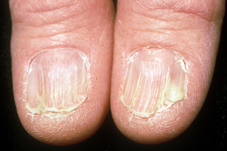 Thinning, splitting nails and some loss of nail due to lichen planus