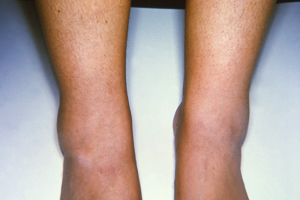 Rubella image figure 3