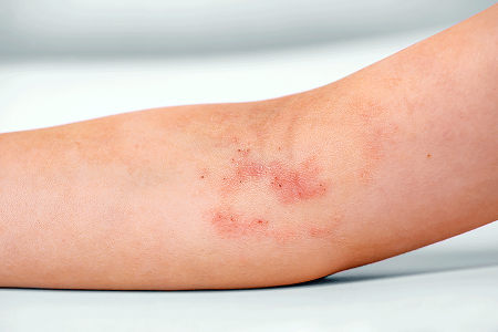 Atopic dermatitis on crook of child’s elbow