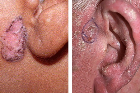 Basal cell carcinoma on Black woman’s face (left) and scaly, basal cell carcinoma next to patient’s ear (right)