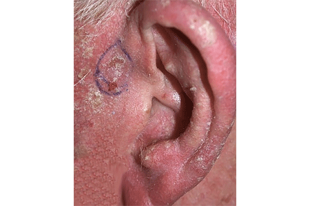 Close-up of scaly patch of skin near the ear develops into basal cell carcinoma