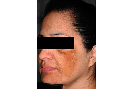 Melasma appears on large area of woman’s face