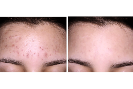 Acne scars before and after treatment by a dermatologist
