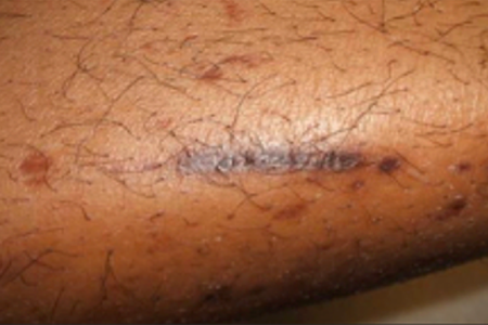 Diabetic dermopathy, or shin spots, are common in people who have diabetes