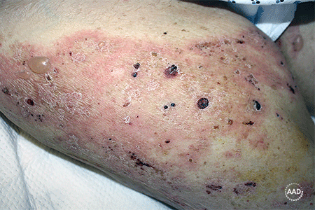 What skin looks like when bullous pemphigoid blisters rupture.