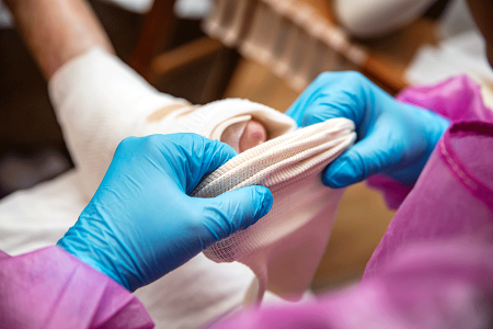 Parent placing bandage over dressing for a child with epidermolysis bullosa