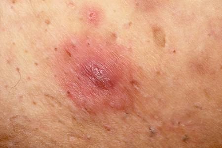 Painful Boils Under Armpits!Could it be Hidradenitis
