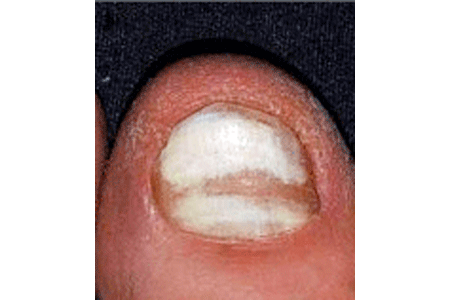 Nail fungus causes changes to this infected nail
