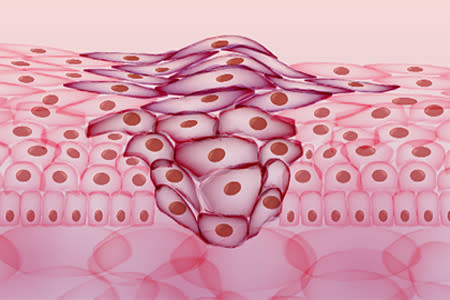 Illustration of a cell mass changing or spreading