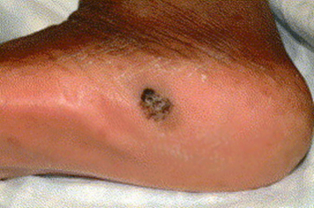 Dark spot on bottom of African descent person could be melanoma