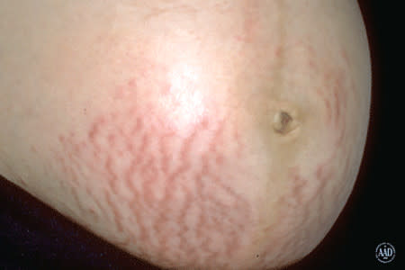 Stretch marks on stomach during pregnancy