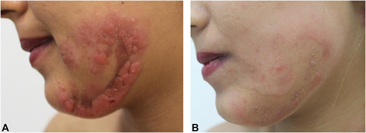 Image of pregnant patient with mycosis fungoides flares for DWII