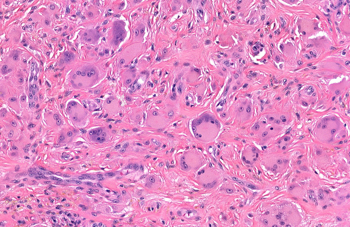 Image for DWII on multicentric reticulohistiocytosis