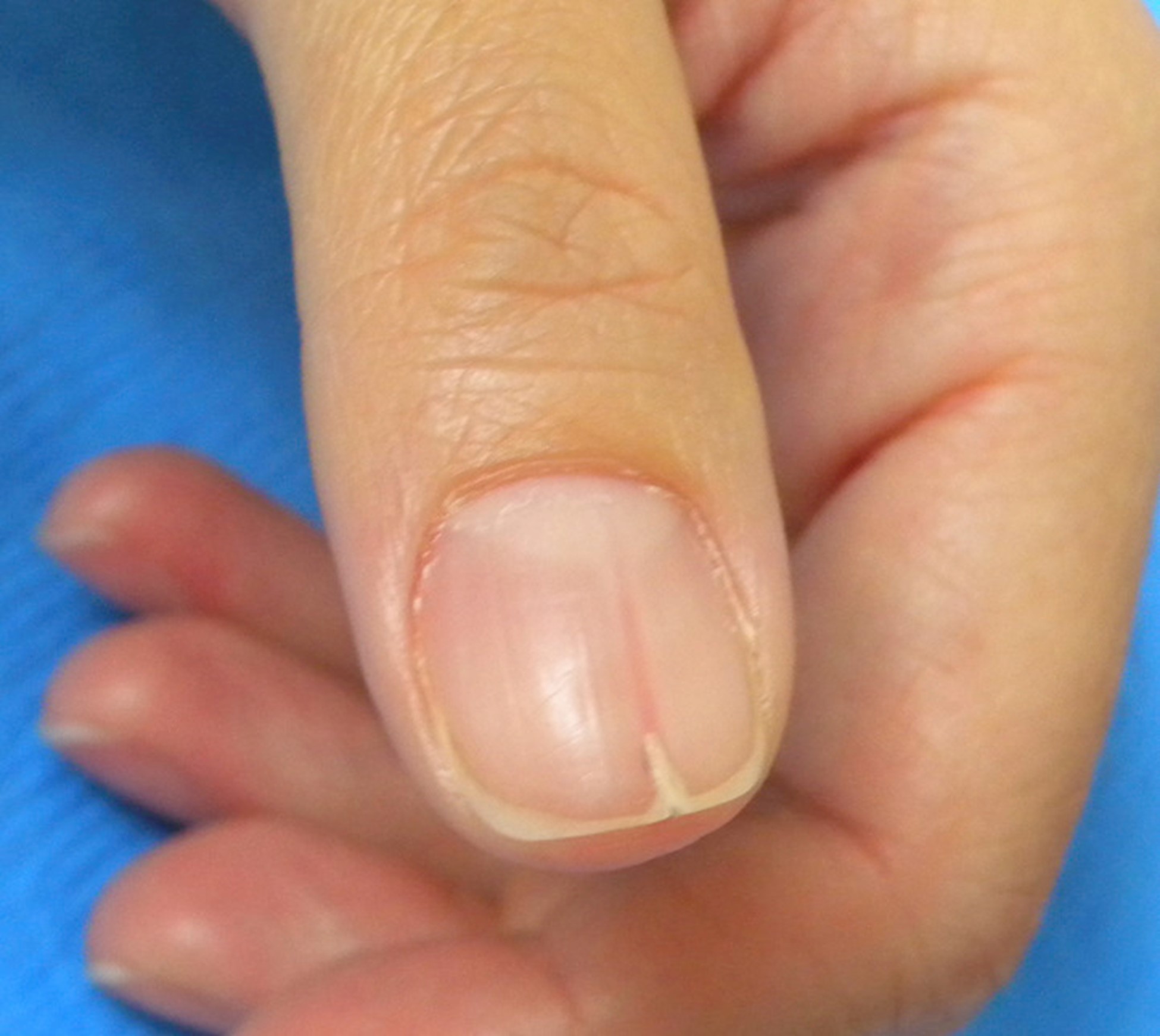 4-71 Darier's disease of the nails