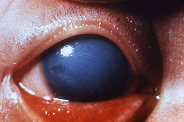 Rubella Figure image 4