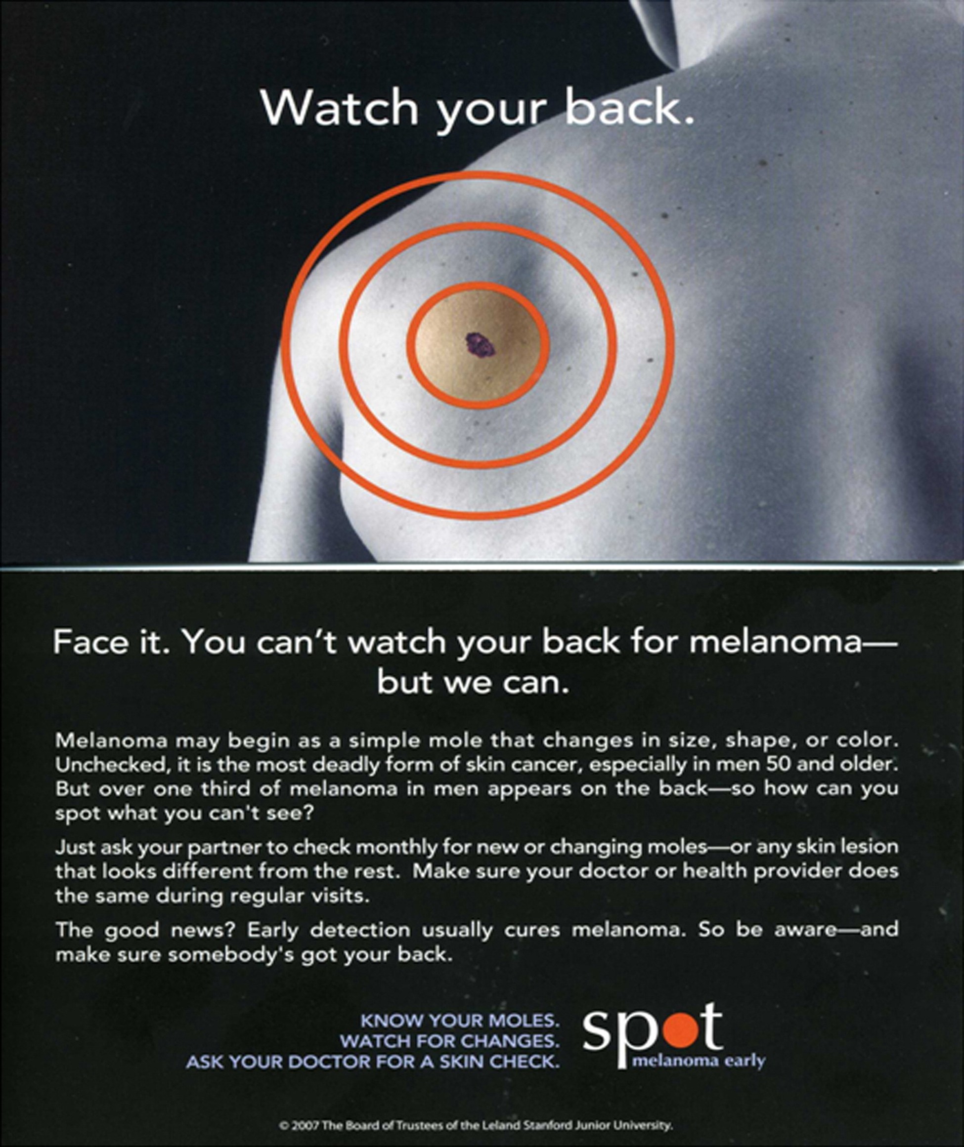 Infographic for AAD about spotting melanoma on the back