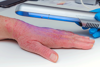Phototherapy treatment on the hand