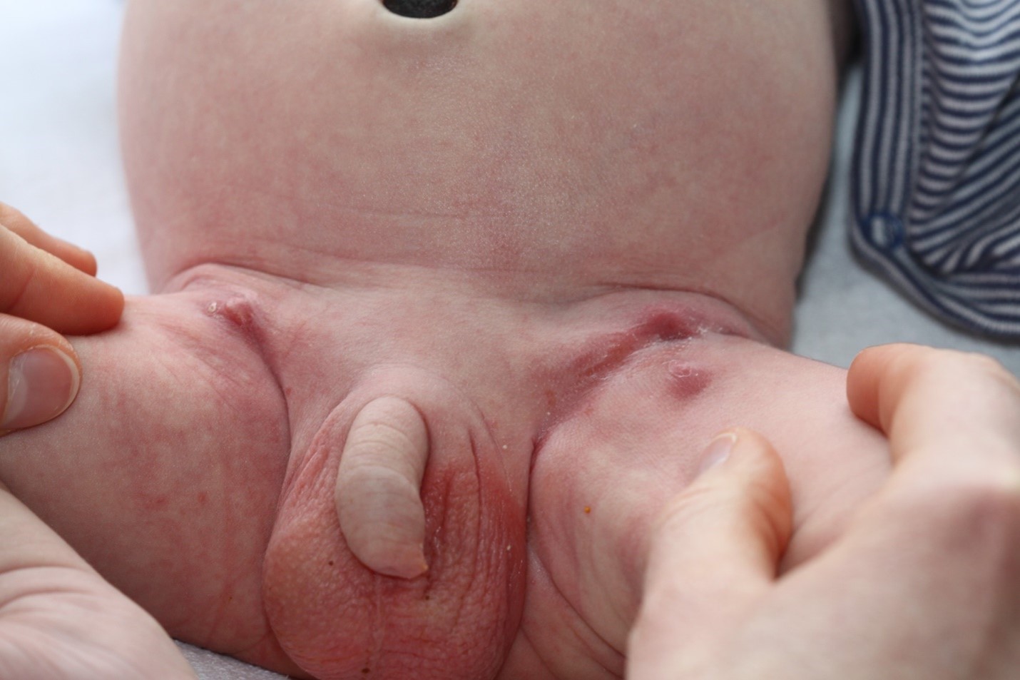 Image for DWII of multiple neonatal staphylococcal cold abscesses of the large folds