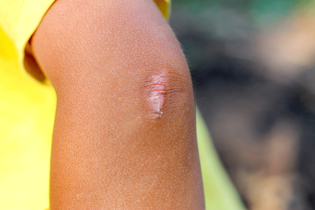 Scar on the elbow of the child