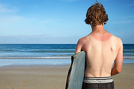 Young man standing on beach with sunburn across his back and shoulders