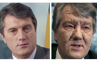 Former Ukrainian President Viktor Yushchenko with chloracne poisoning.