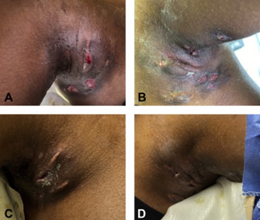 Image for DWII on hidradenitis suppurativa and amyloid A amyloidosis