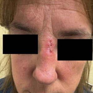 DLE on the face of a man with a lighter skin tone, as a before picture for treatment with tapinarof | American Academy of Dermatology (AAD)