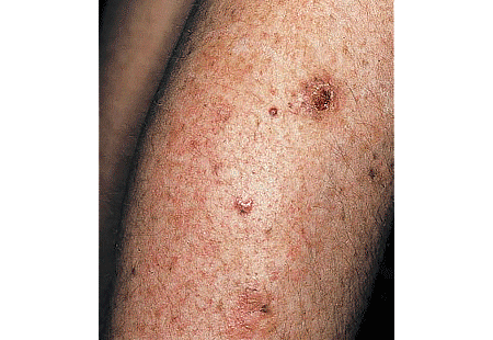 Girl with xeroderma pigmentosum develops skin cancer on her leg