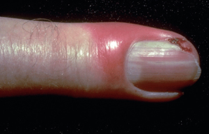 Infection around fingernail