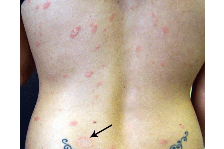 pityriasis rosea rash on woman’s back