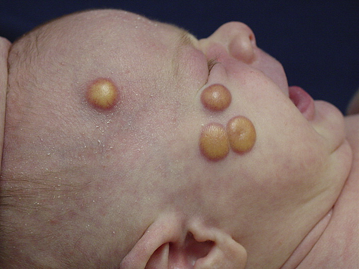 Image for DWII of xanthogranulomas