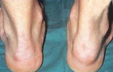 Swollen Achilles tendon with psoriatic arthriti
