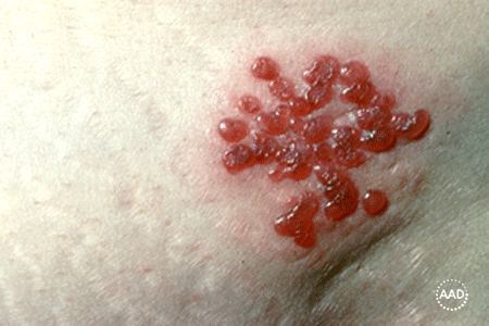 Close-up of shingles rash